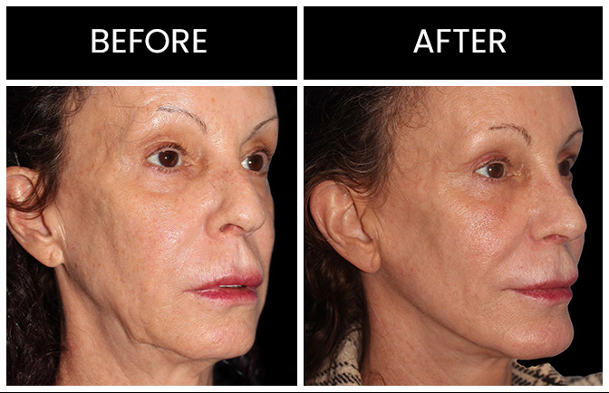 CO2 Laser Skin Resurfacing Results Atlanta